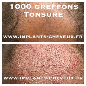 Greffe capillaire FUE 1000 greffons